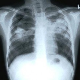 Hari Tuberkolosis Sedunia